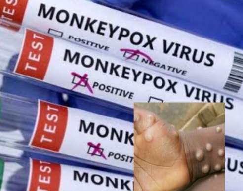 Monkeypox Testing